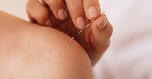 Dry Needling Relief, LLC